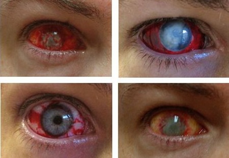 Eye-Trauma-Contact-Lenses